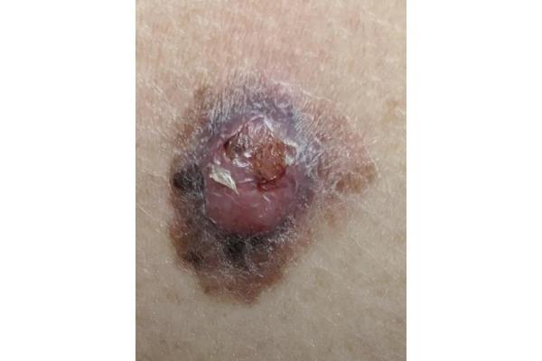 How to protect yourself from melanoma, skin cancer detection.