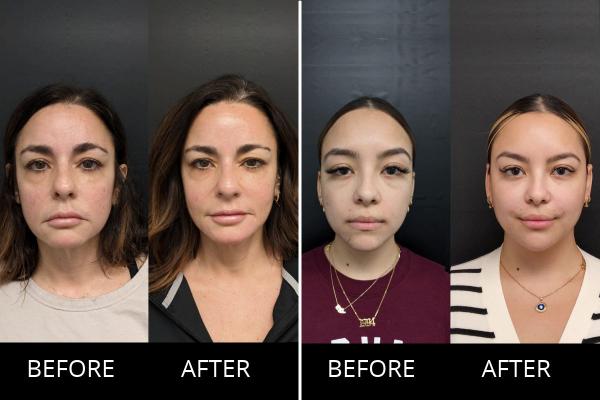Facial Balancing with Fillers