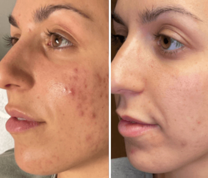 Before and after results of TheSaltFacial® treatment showing improved skin texture, acne, and radiance