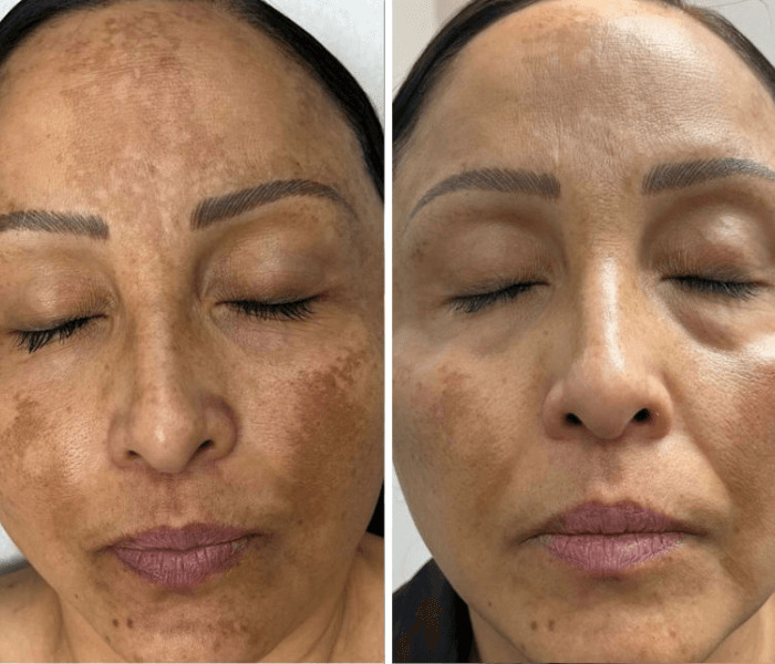 Before and after results of TheSaltFacial® treatment showing improved skin texture and radiance, and reduced skin spots