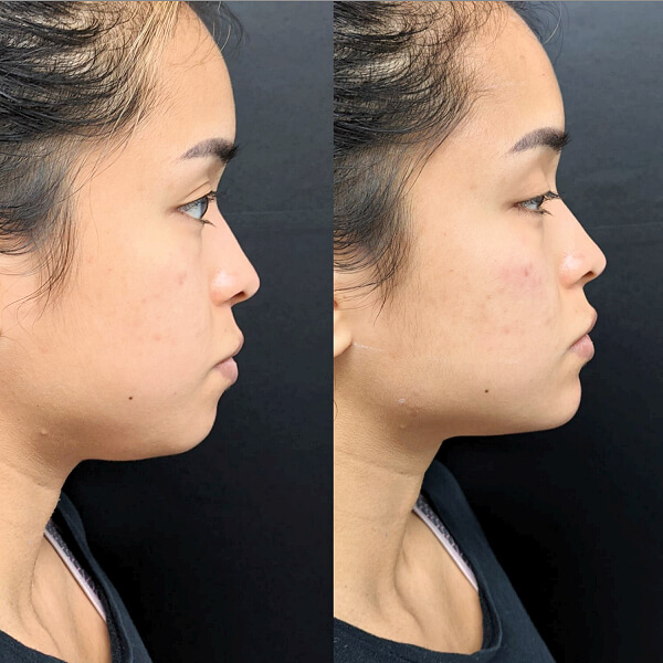 Chin Filler Before and After
