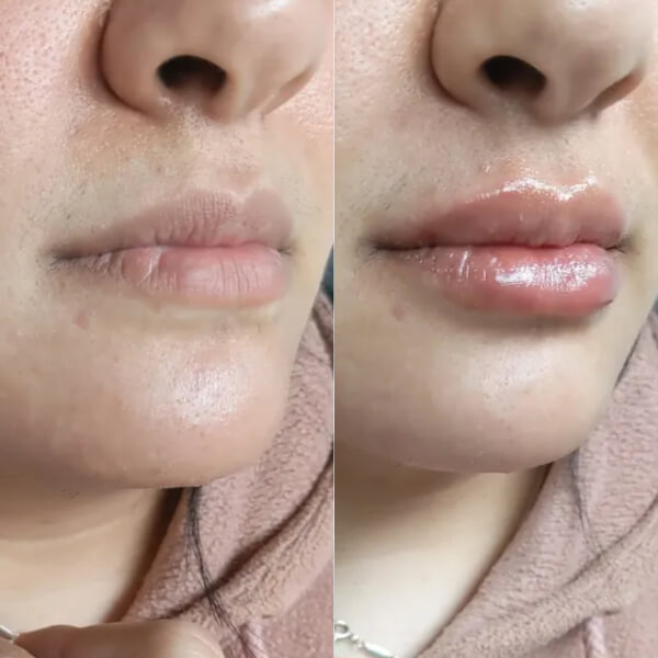 Lip Enhancement