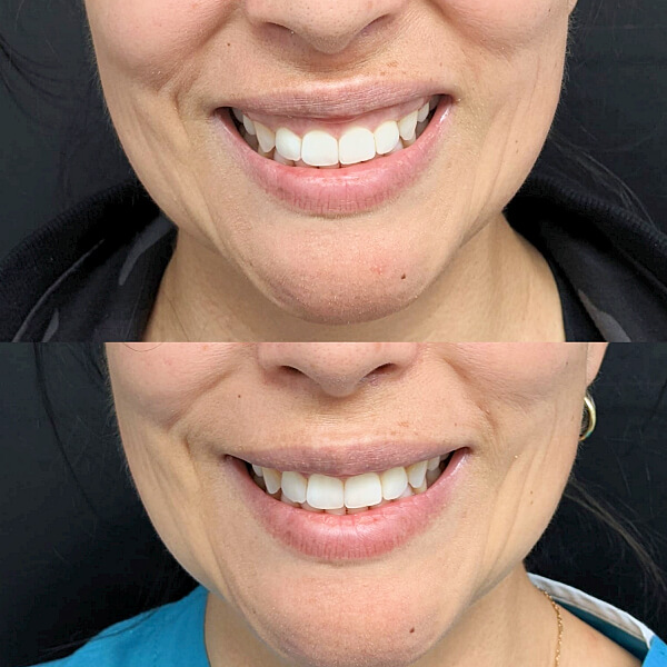 Gummy Smile Correction