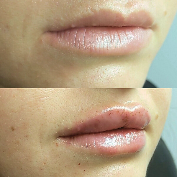 Before and After Lip Enhancement