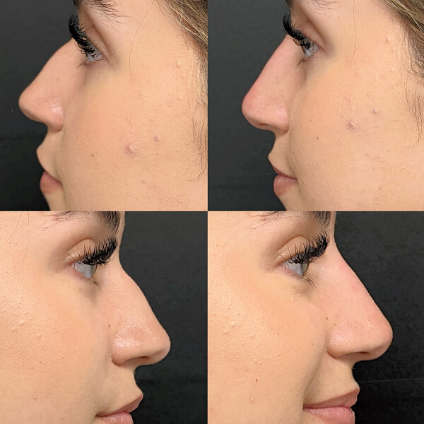 Before and After Liquid Nose Job - Liquid Rhinoplasty with Filler